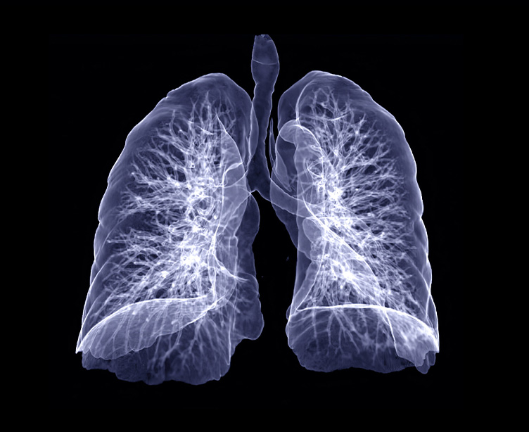 Lung Nodules
