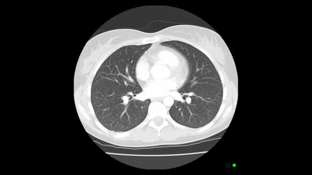 Lung Cancer Screening
